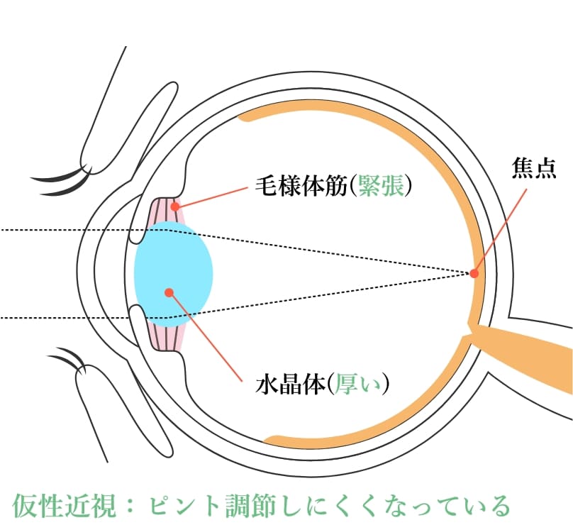 遠距離時の仮性近視の人の目の構造